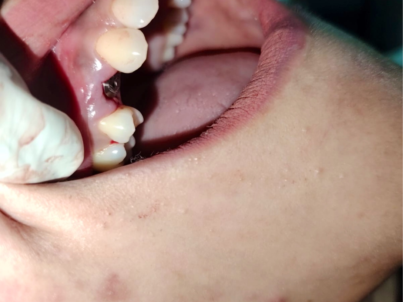 Close clinical view of dental implant treatment