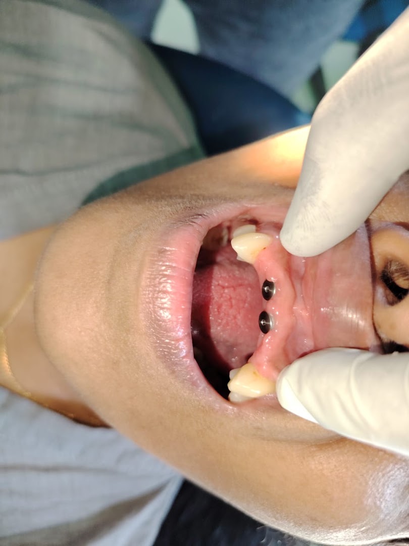 Close clinical view of dental implant components