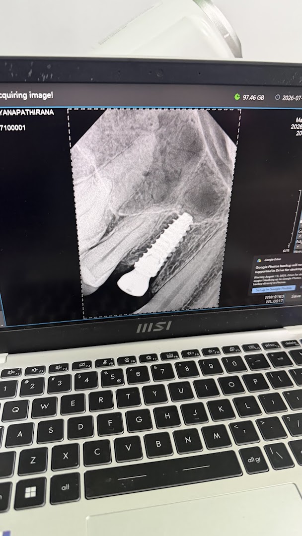 Dental radiograph showing an implant on a laptop screen